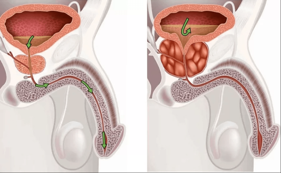 Příznaky prostatitidy